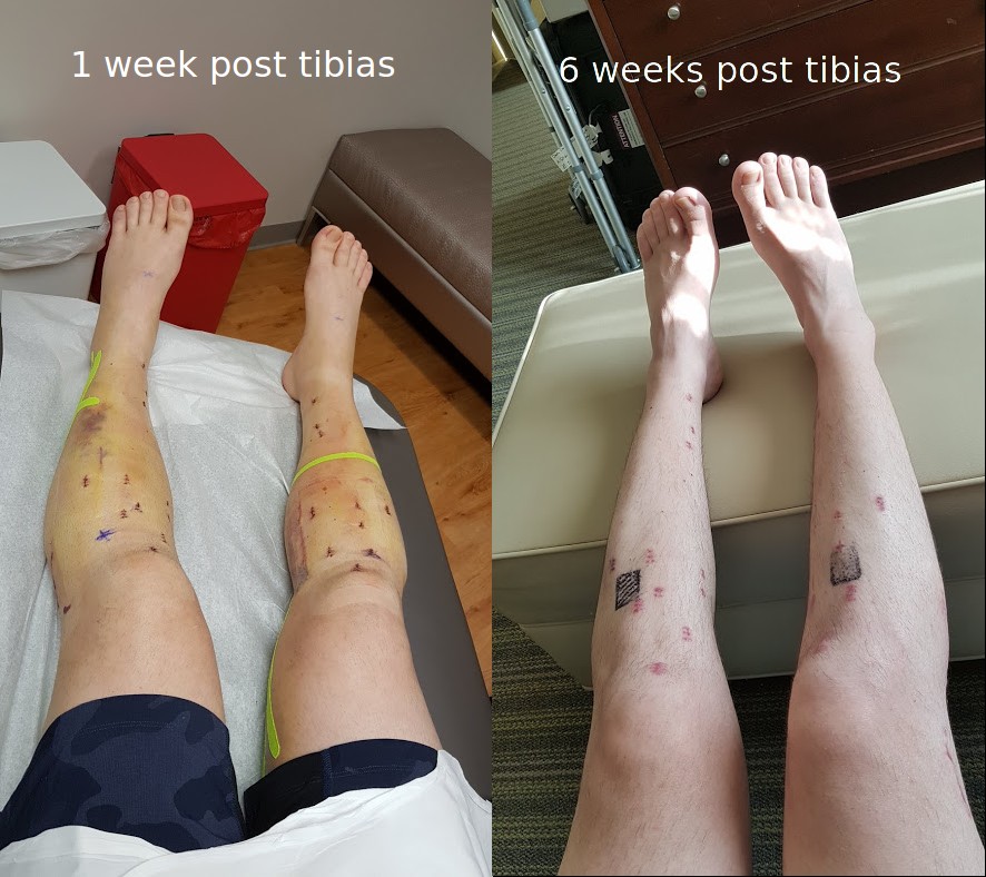 Tibias-muscle-loss